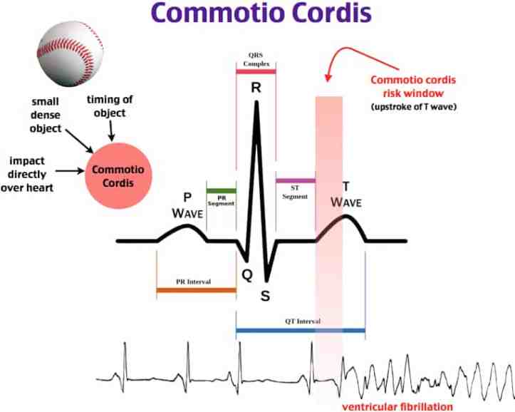 cordis-cardiac-sudden-pathophysiology-commotio-original